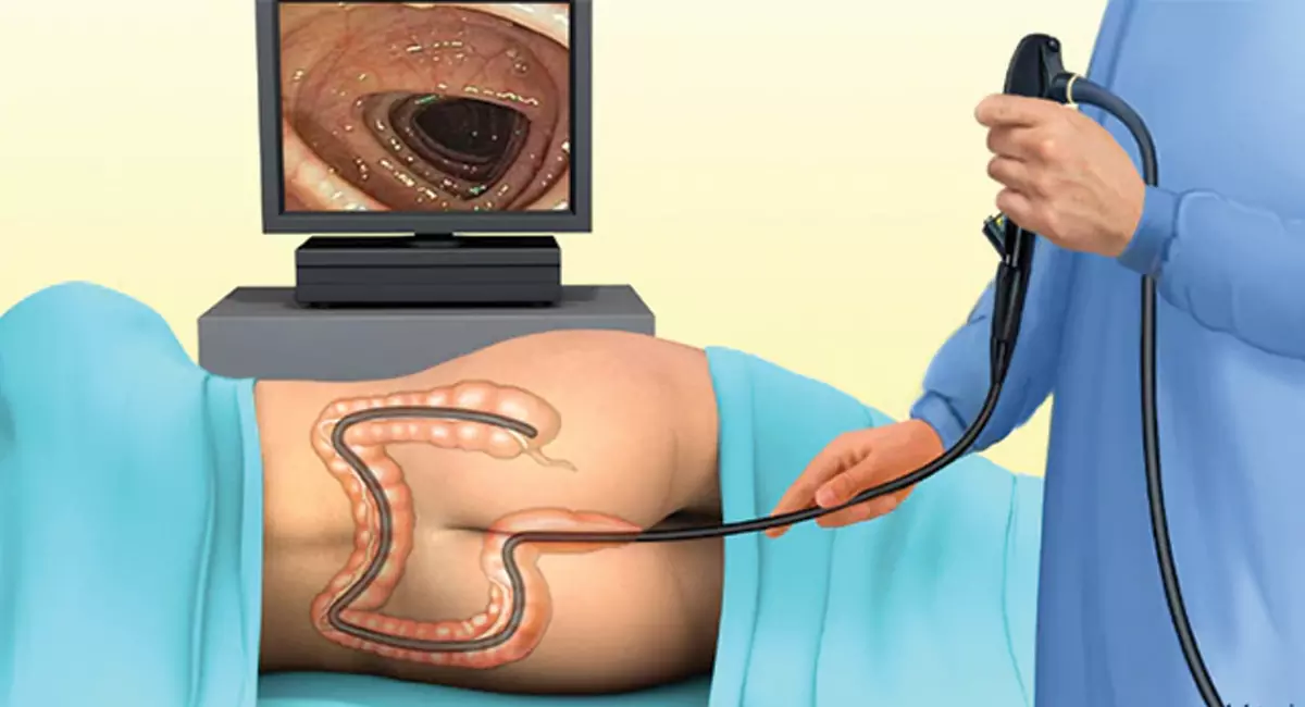Colonoscopy.webp