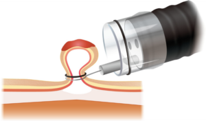 Endoscopic Mucosal Resection