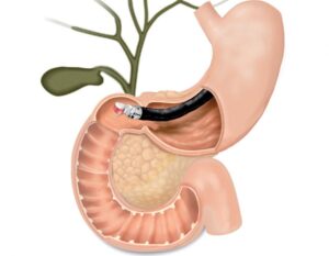 Endoscopic Ultrasound