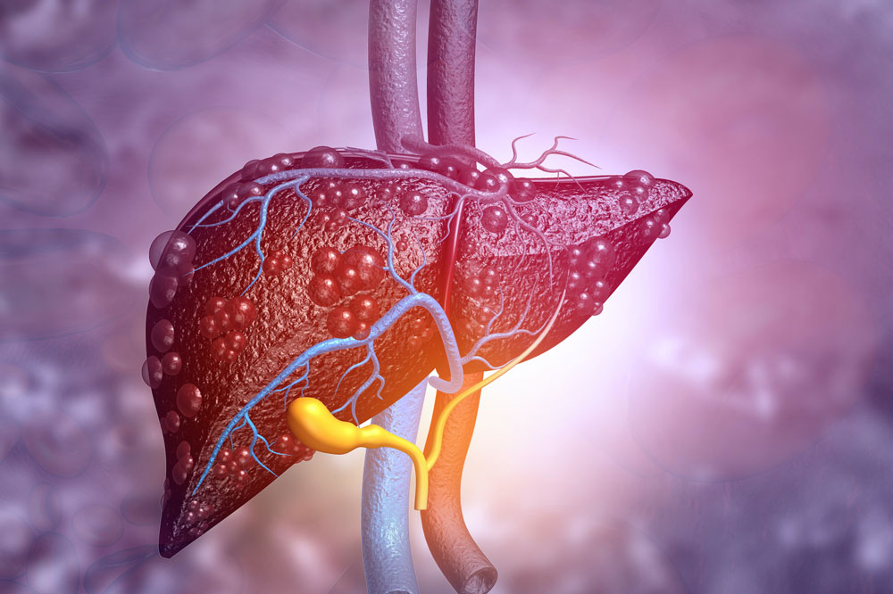 Read more about the article Liver Cirrhosis