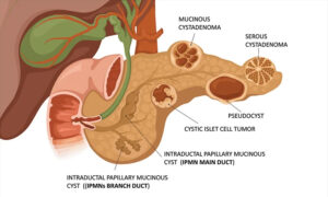 Pancreatic Cysts