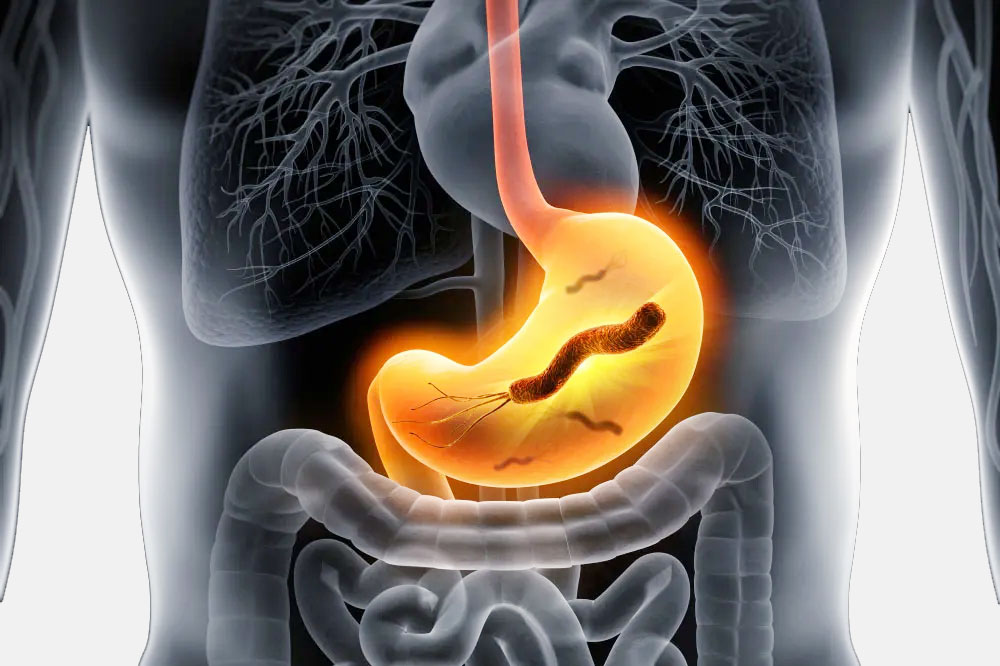 Read more about the article Helicobacter Pylori Infection