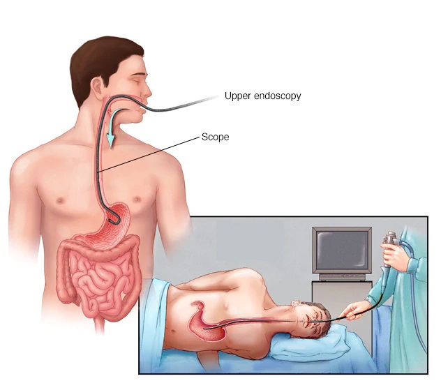 Endoscopic Ultrasound