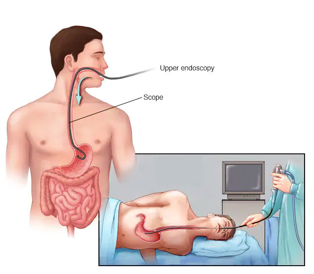 Read more about the article How do Endoscopy and Gastroscopy Differ?