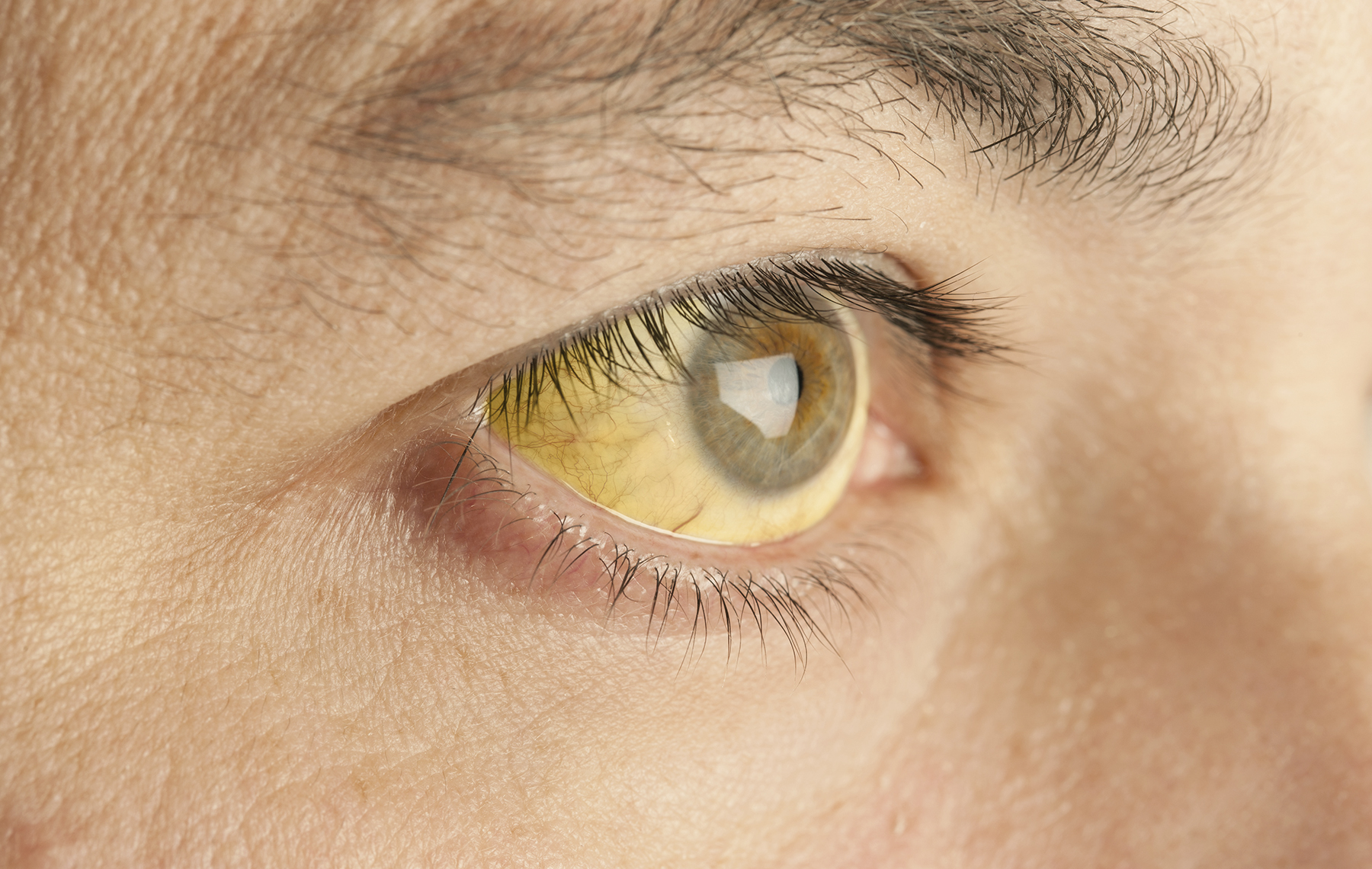 Read more about the article Hepatitis Isn’t Just a ‘Risk Group’ Disease. Know the Signs